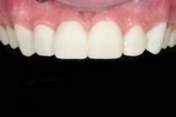 After Veneers